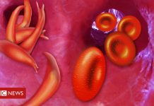 Tracing sickle cell back to one child, 7,300 years ago