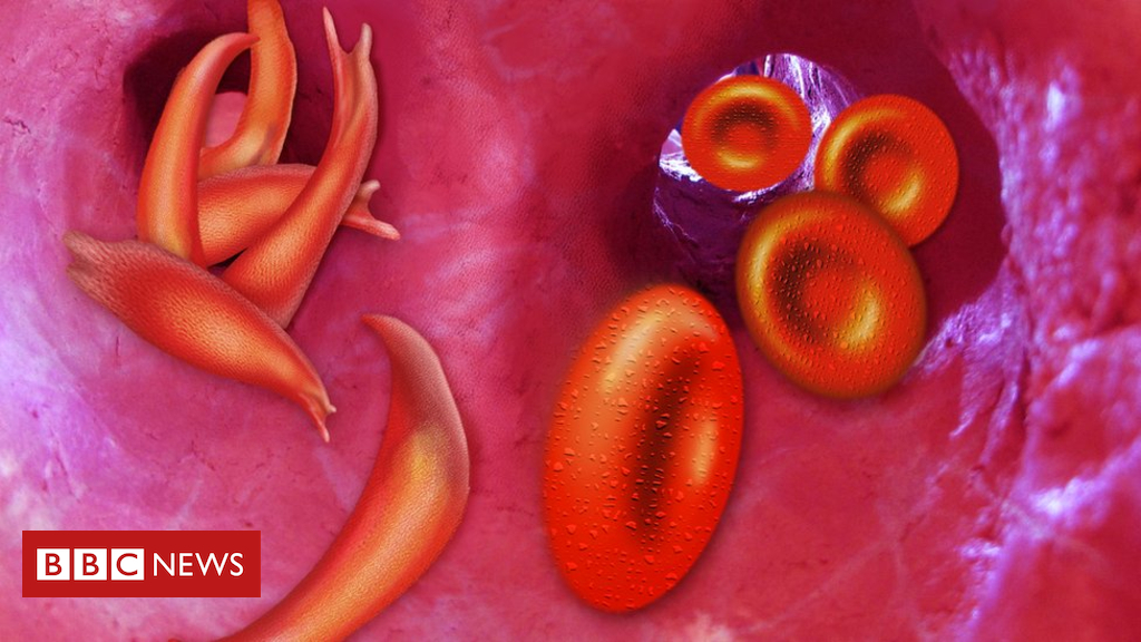 tracing-sickle-cell-back-to-one-child-7300-years-ago.jpg